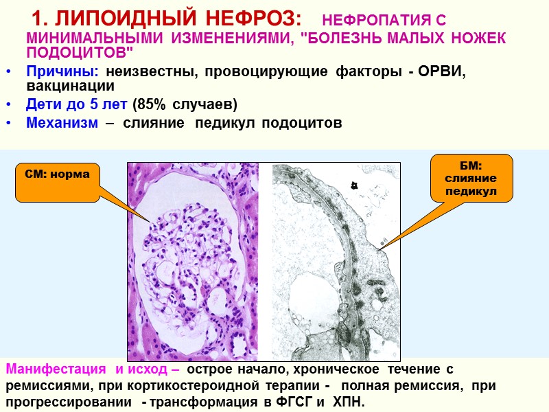 1. ЛИПОИДНЫЙ НЕФРОЗ:   НЕФРОПАТИЯ С МИНИМАЛЬНЫМИ ИЗМЕНЕНИЯМИ, 